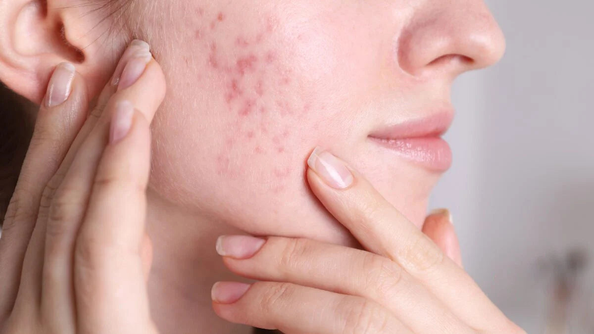 Acne