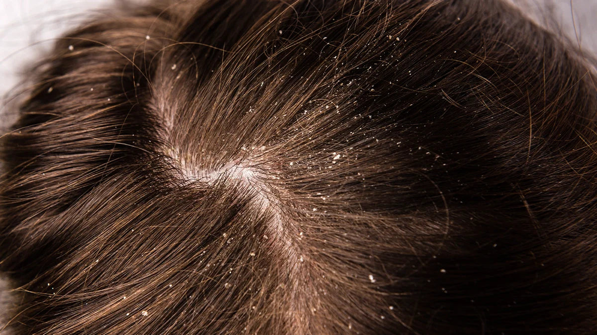 Dandruff & Flaky Scalp